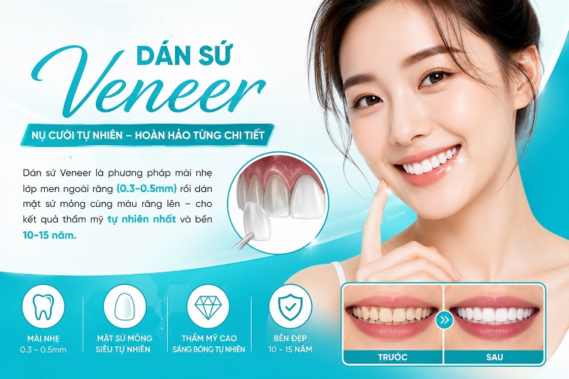 Dán sứ Veneer là phương pháp mài nhẹ lớp men ngoài răng (0.3-0.5mm)