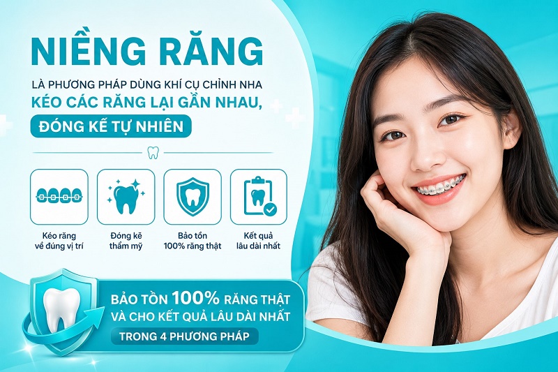 Niềng răng là phương pháp dùng khí cụ chỉnh nha kéo các răng lại gần nhau,