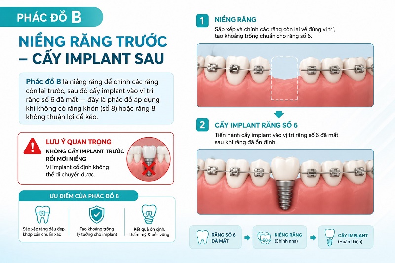 Niềng răng kết hợp cấy implant số 6 sau niềng