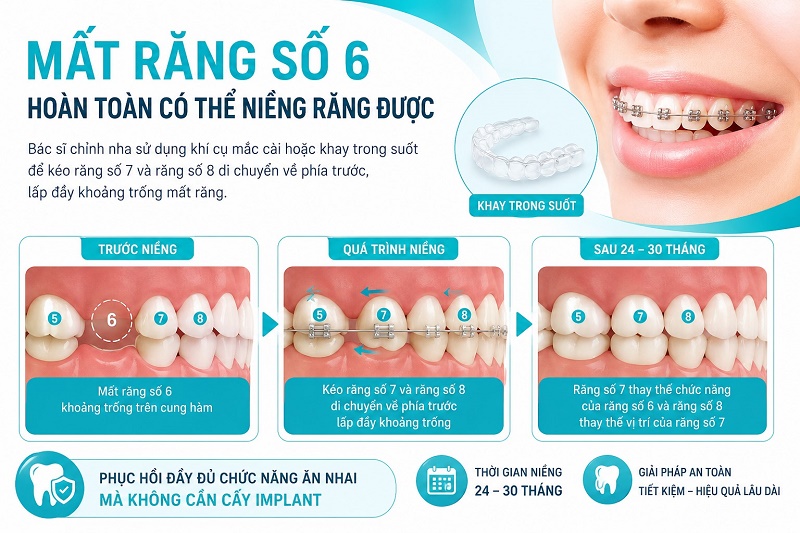 Mất răng số 6 hoàn toàn có thể niềng răng được bác sĩ chỉnh nha sử dụng khí cụ mắc cài