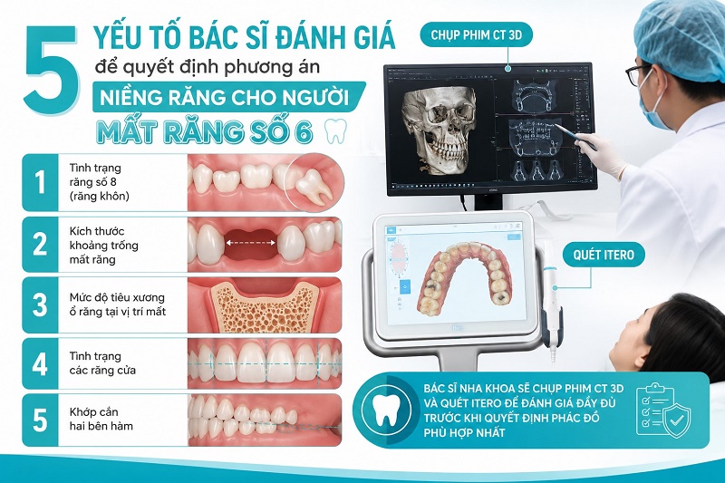 5 yếu tố bác sĩ đánh giá để quyết định phương án niềng răng cho người mất răng số 6 gồm