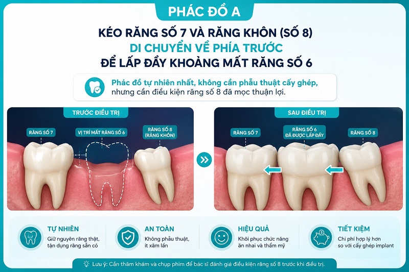 Phác đồ A — Kéo răng số 7 và số 8 đóng khoảng