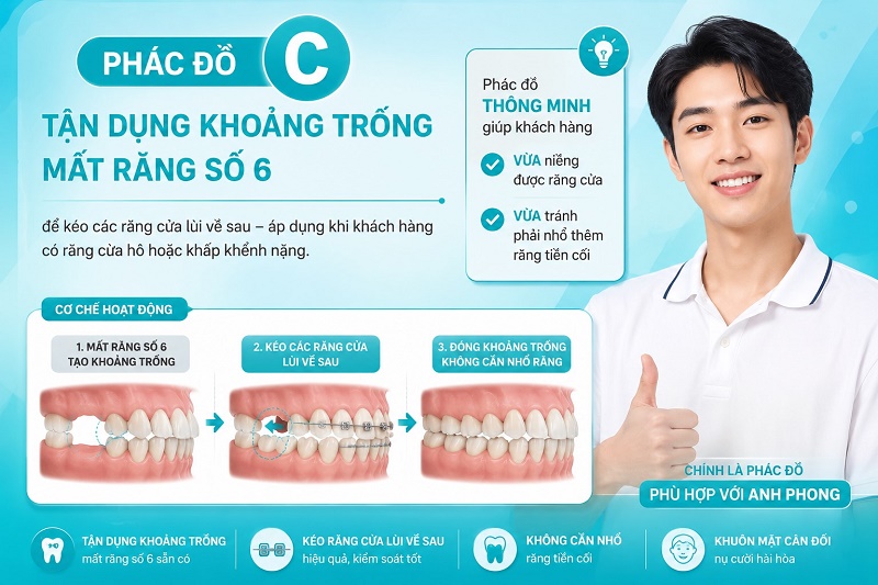 Tận dụng khoảng mất răng để chỉnh răng cửa chen chúc