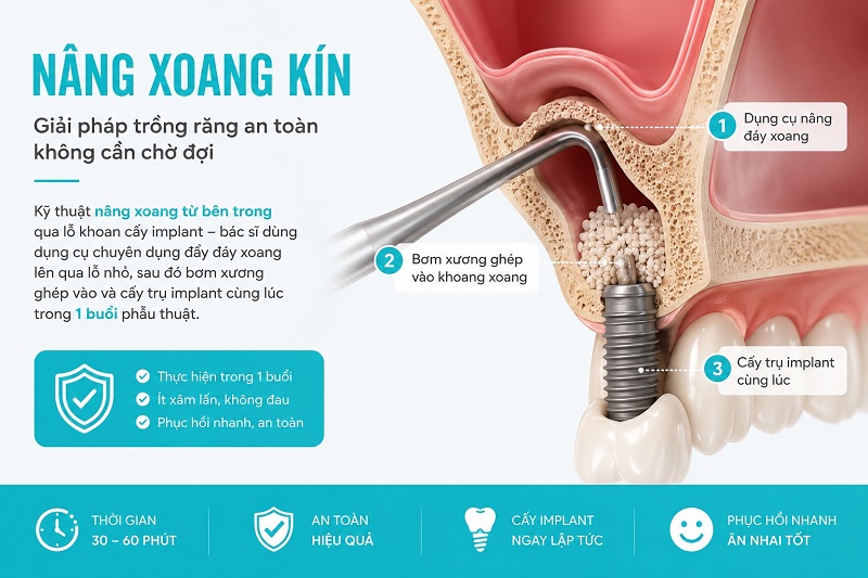 Nâng xoang kín là kỹ thuật nâng xoang từ bên trong qua lỗ khoan cấy implant