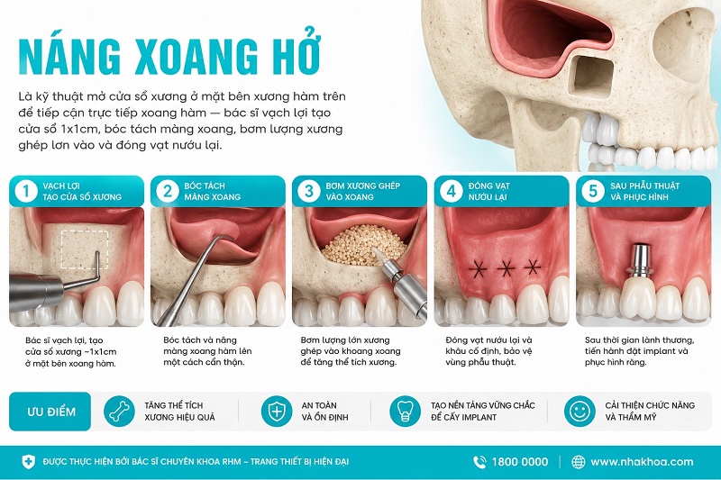 Nâng xoang hở là kỹ thuật mở cửa sổ xương ở mặt bên xương hàm trên để tiếp cận trực tiếp