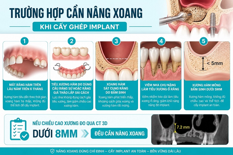 trường hợp cần nâng xoang khi cấy ghép implant gồm: mất răng hàm trên lâu năm trên 6 tháng