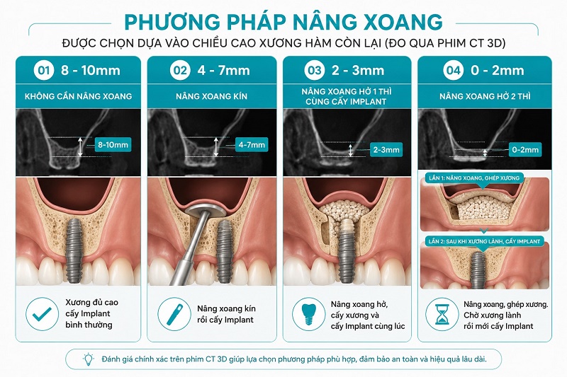 phương pháp nâng xoang được chọn dựa vào chiều cao xương hàm còn lại đo qua phim CT 3D