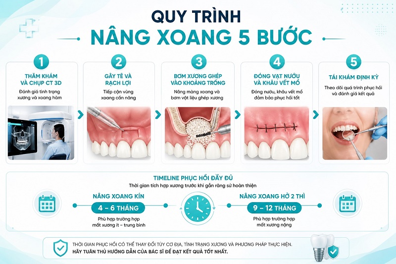 Quy trình nâng xoang gồm 5 bước cơ bản: thăm khám và chụp CT 3D đánh giá xương,