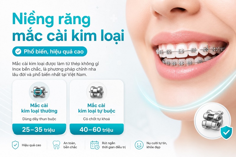 Mắc cài kim loại được làm từ thép không gỉ Inox bền chắc, là phương pháp chỉnh nha lâu đời và phổ biến nhất tại Việt Nam.
