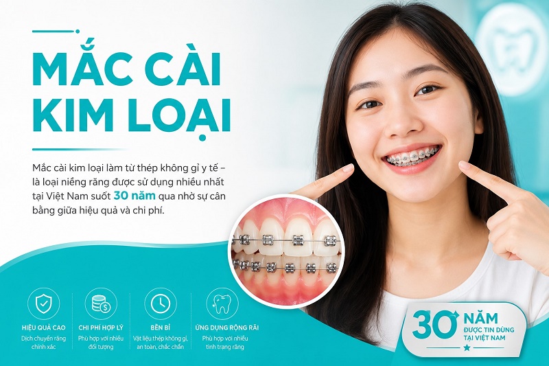 Ưu nhược điểm niềng răng trong suốt và mắc cài