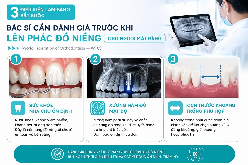 Có 3 điều kiện lâm sàng bắt buộc mà bác sĩ cần đánh giá trước khi lên phác đồ niềng cho người mất răng (World Federation of Orthodontists — WFO): sức khỏe nha chu ổn định, xương hàm đủ mật độ, và kích thước khoảng trống phù hợp với hướng xử lý.