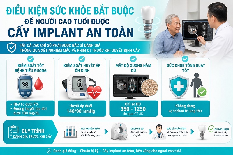Quy trình cấy implant cho người cao tuổi gồm 5 bước thực hiện trong 1-2 buổi