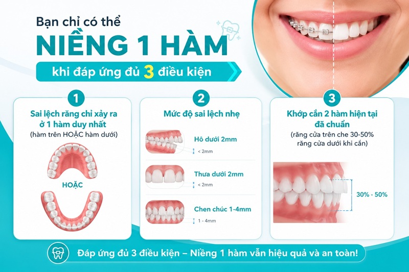 Trường hợp niềng 1 hàm hay 2 hàm