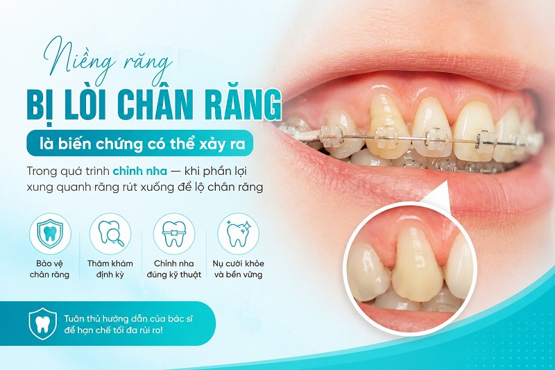 Niềng răng bị lòi chân răng là biến chứng có thể xảy ra trong quá trình chỉnh nha