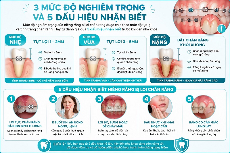 mức độ nghiêm trọng của niềng răng bị lòi chân răng được chia theo mức độ tụt lợi
