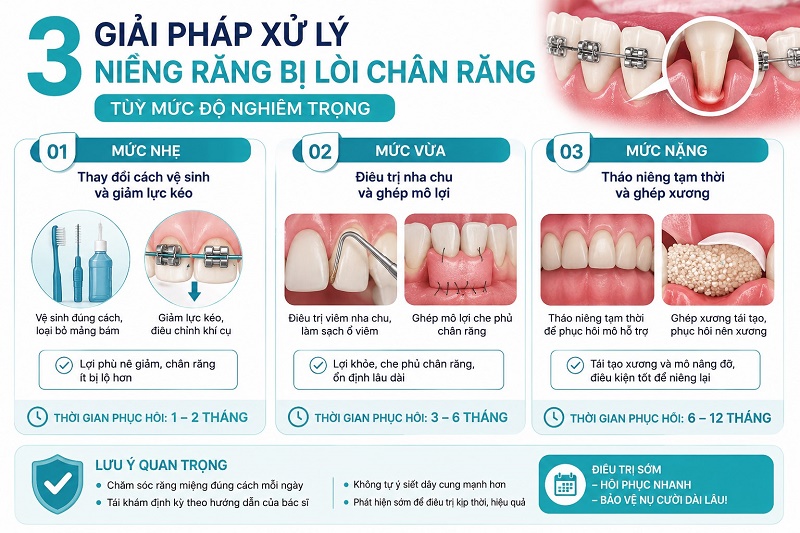 3 giải pháp xử lý niềng răng bị lòi chân răng tuỳ mức độ nghiêm trọng: mức nhẹ