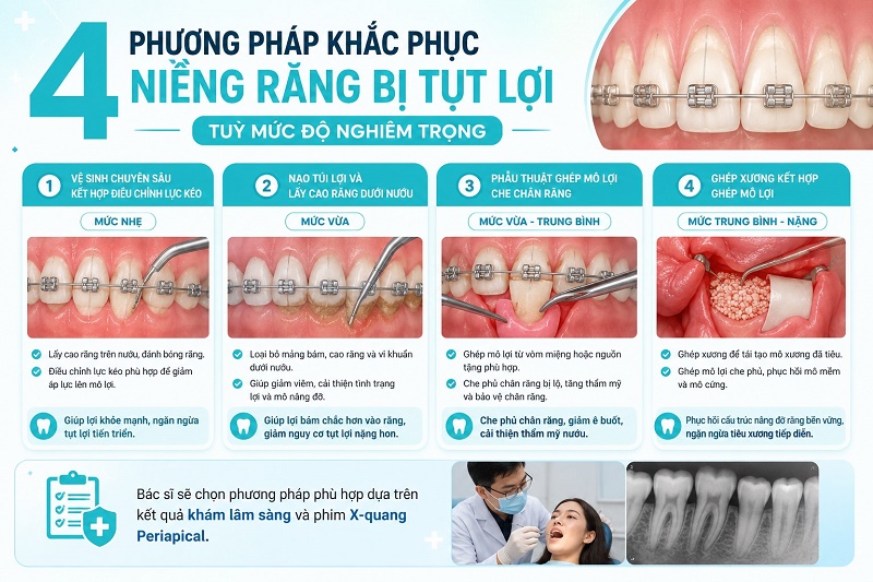 4 phương pháp khắc phục niềng răng bị tụt lợi tuỳ mức độ nghiêm trọng gồm: vệ sinh chuyên sâu kết hợp điều chỉnh lực kéo