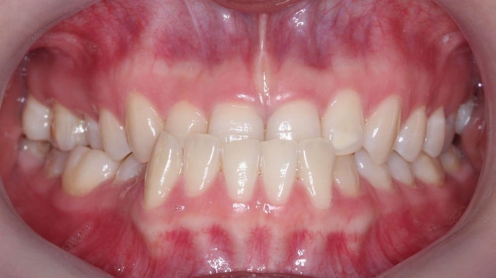 Phân biệt móm do răng và móm do xương ở trẻ