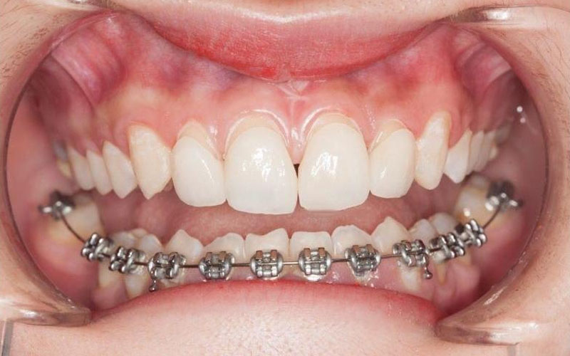 Niềng răng móm cho trẻ - phương pháp tùy nguyên nhân móm