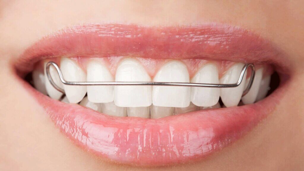 Trẻ em niềng răng hô móm sớm 6-12 tuổi tại Smile One