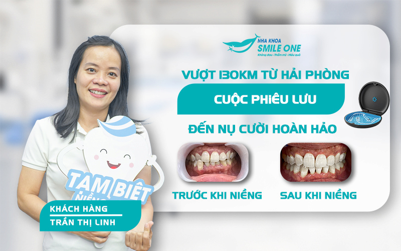 Phim Cephalometric phân tích các chỉ số hô móm tại Smile One