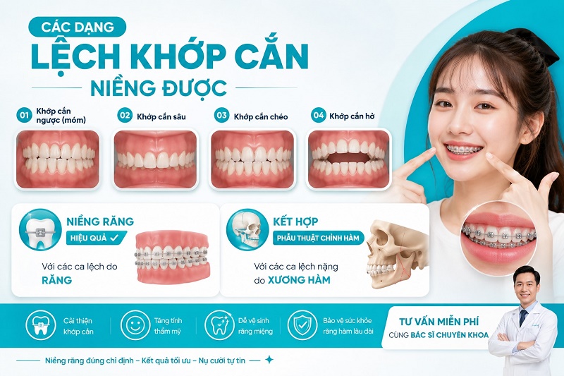 Các dạng lệch khớp cắn niềng được gồm khớp cắn ngược (móm), khớp cắn sâu, khớp cắn chéo và khớp cắn hở.