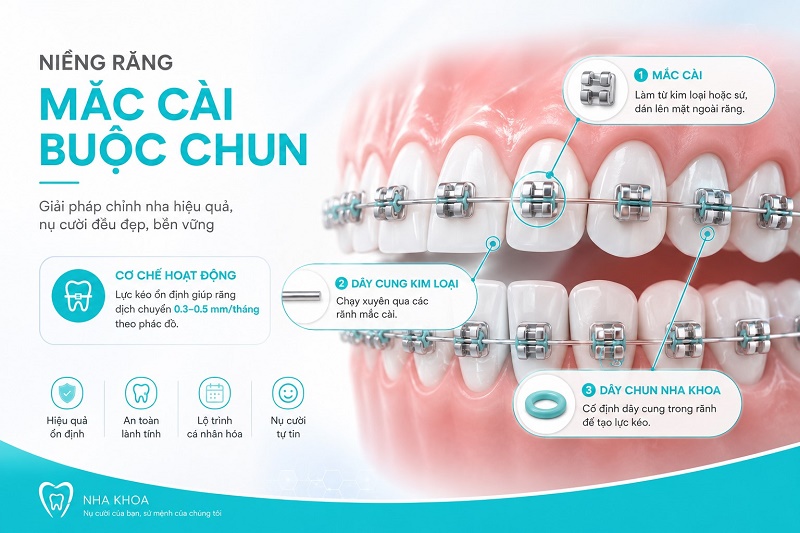 mắc cài làm từ kim loại hoặc sứ được dán lên mặt ngoài răng, dây cung kim loại chạy qua các rãnh mắc cài,