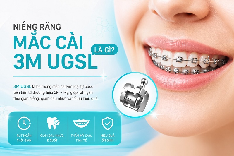 Niềng răng mắc cài 3M UGSL là phương pháp chỉnh nha sử dụng hệ thống mắc cài tự buộc Ultra Glide Self-Ligating