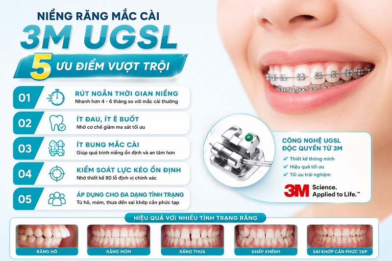 Niềng răng mắc cài 3M UGSL có 5 ưu điểm: rút ngắn thời gian niềng 4-6 tháng so với mắc cài thường,