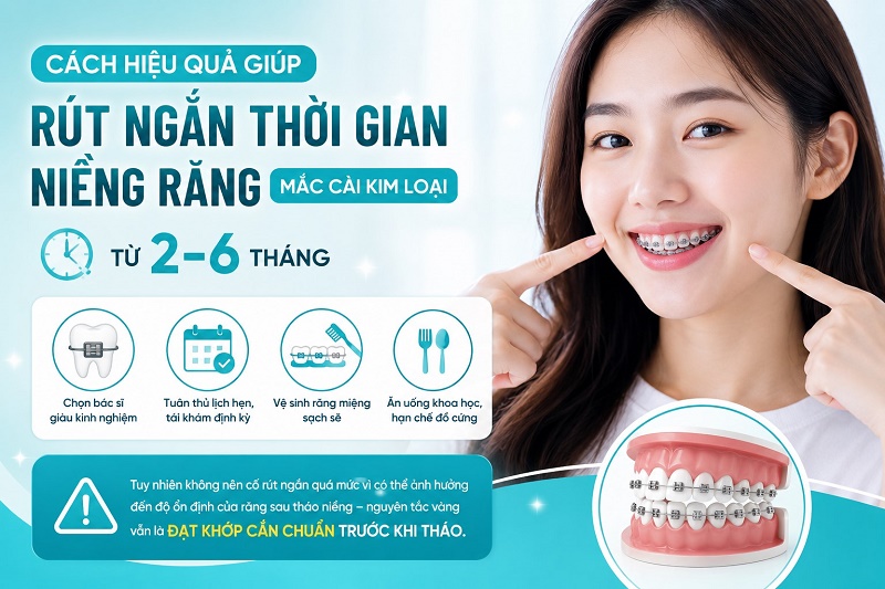 Thời gian niềng răng mắc cài kim loại dao động từ 6 tháng đến 36 tháng