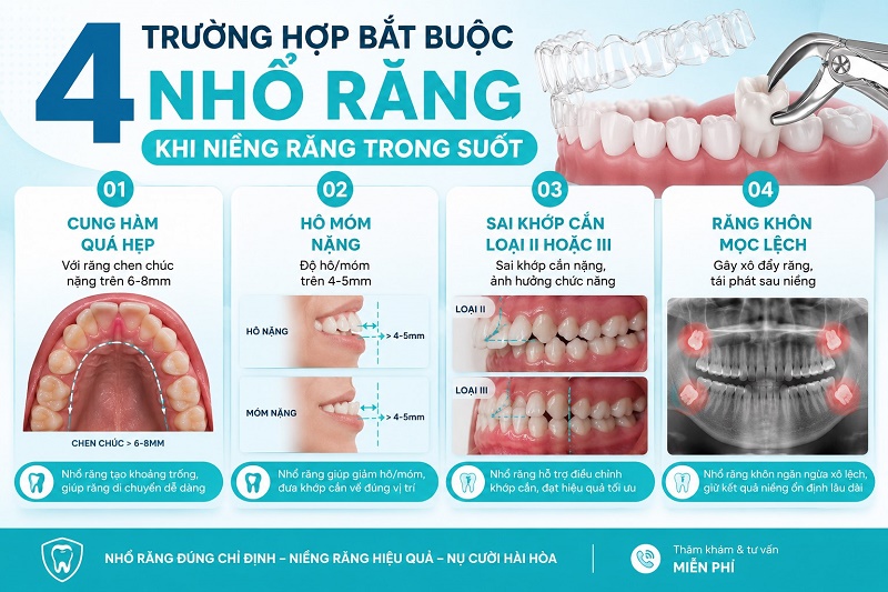 Trường hợp cần nhổ răng và nhổ răng nào khi niềng trong suốt