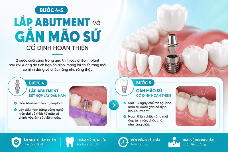 2 bước cuối cùng trong quá trình cấy ghép Implant là lắp Abutment kết hợp lấy dấu hàm