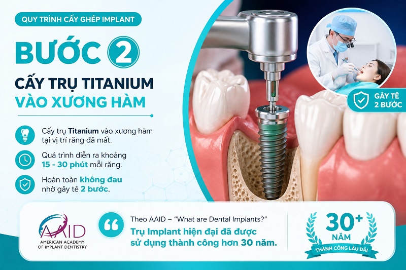 Bước 2 trong quá trình cấy ghép Implant là cấy trụ Titanium vào xương hàm tại vị trí răng đã mất