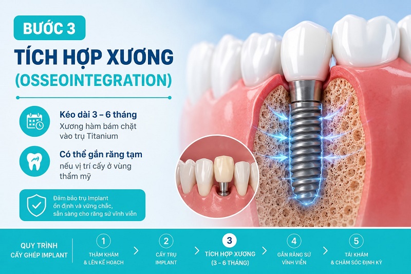 Bước 3 trong quá trình cấy ghép Implant là giai đoạn tích hợp xương (osseointegration)
