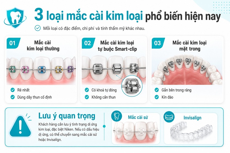 mắc cài kim loại thường (rẻ nhất, dùng dây thun cố định), mắc cài kim loại tự buộc Smart-clip