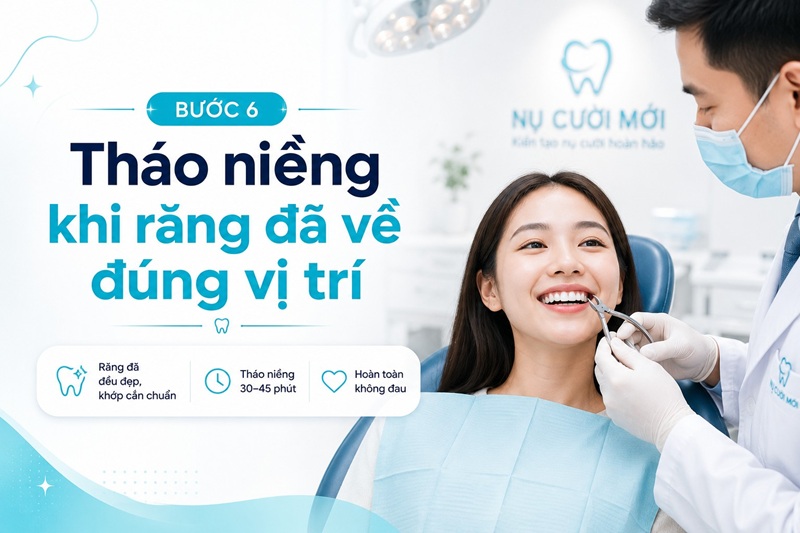 Tháo niềng khi răng đã về đúng vị trí