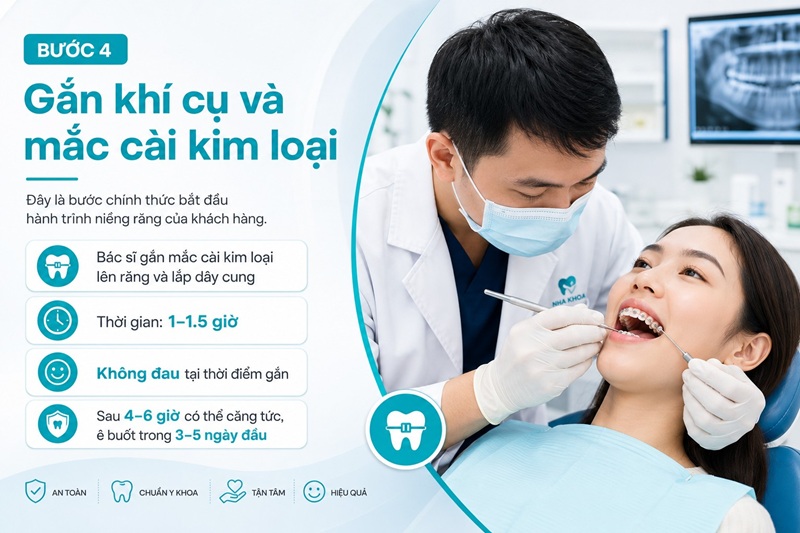 Gắn khí cụ và mắc cài kim loại