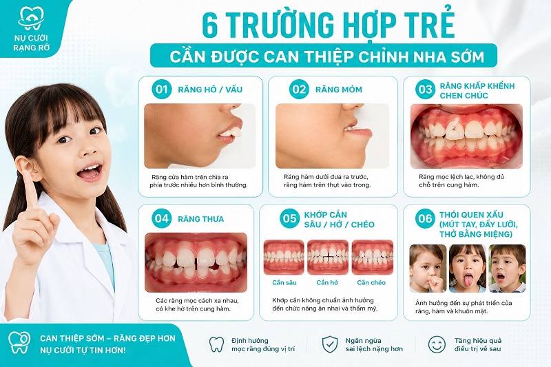 Có 6 trường hợp trẻ cần được can thiệp chỉnh nha sớm: răng hô/vẩu, răng móm, răng khấp