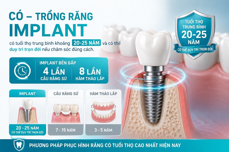 Trồng răng Implant có tuổi thọ trung bình khoảng 20-25 năm