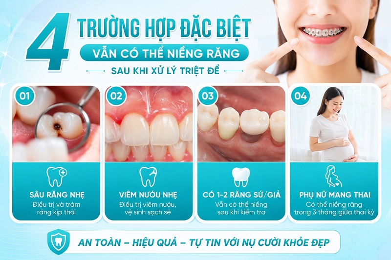 Có 4 trường hợp đặc biệt vẫn có thể niềng răng sau khi xử lý triệt để