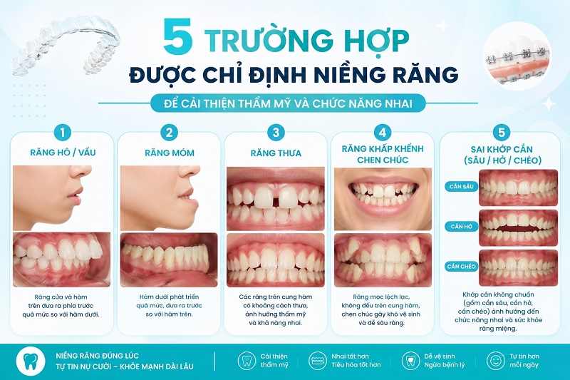 Có 5 trường hợp được chỉ định niềng răng để cải thiện thẩm mỹ và chức năng nhai: