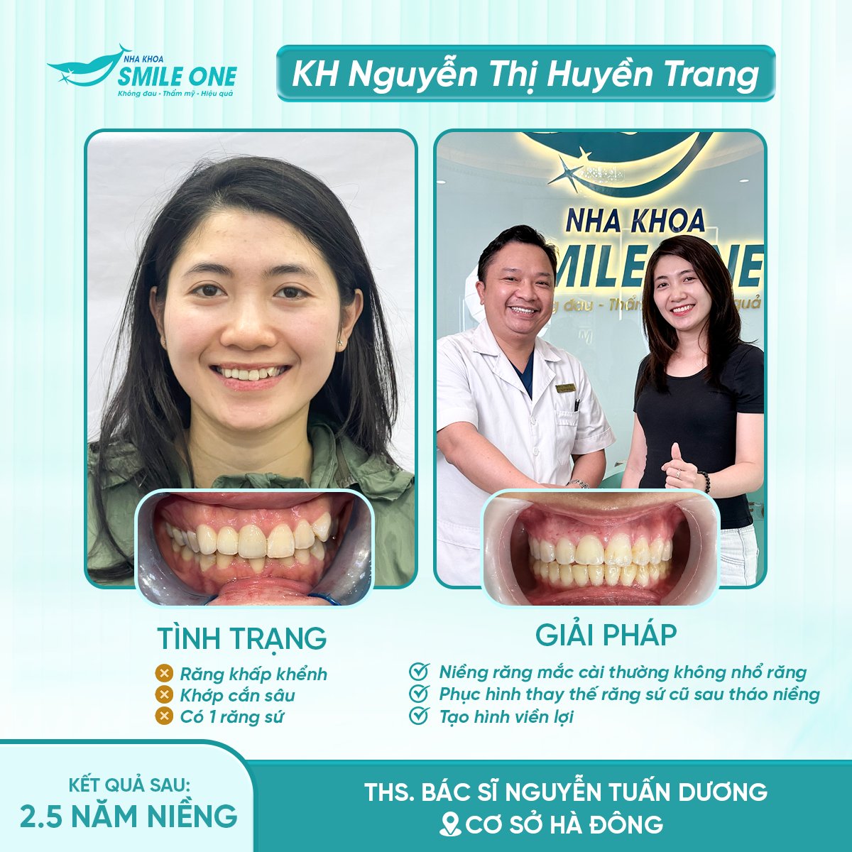 Trước và sau niềng răng mắc cài không nhổ răng của chị Nguyễn Thị Huyền Trang tại Smile One Hà Đông