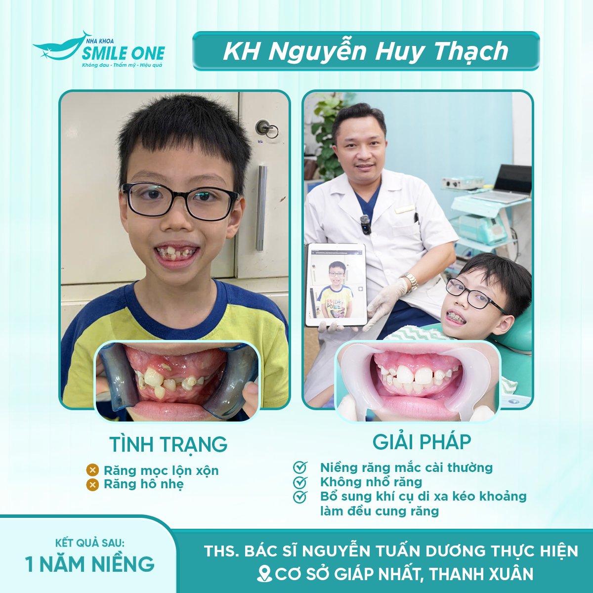 So sánh tình trạng và giải pháp — kết quả sau 1 năm niềng mắc cài của bé Nguyễn Huy Thạch tại Smile One