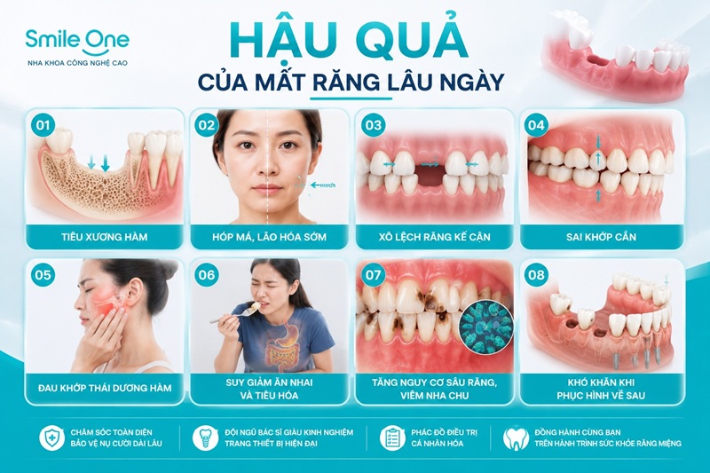 Mất răng lâu năm kéo theo nhiều hậu quả nối tiếp nhau, đều bắt nguồn từ việc xương hàm không còn lực nhai kích thích nên tiêu dần chỉ sau khoảng 3 tháng.