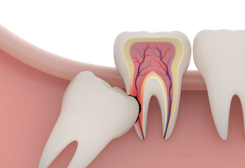 Nên nhổ răng số 8 khi bị đau nhức hoặc sưng tấy