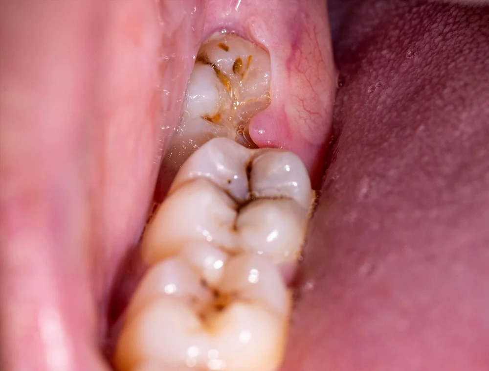 Răng số 8 nhổ rồi không thể mọc lại được