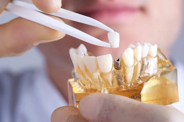 Nhổ răng sau 2 - 4 tháng có thể trồng với phương pháp implant