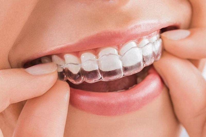 Niềng răng nhằm sắp xếp, điều chỉnh các răng lệch lạc, hô, móm, thưa... về đúng vị trí