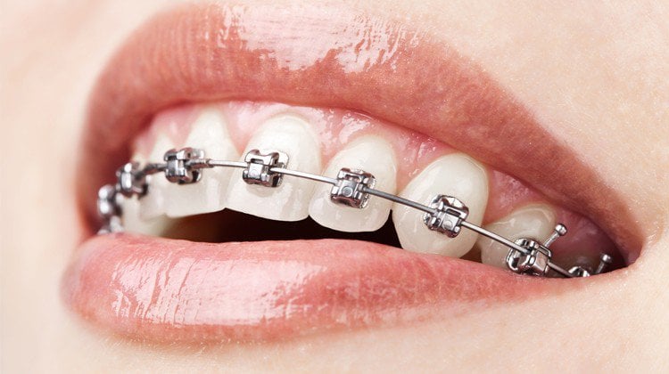 Mắc cài kim loại là phương pháp niềng răng phổ biến hiện nay