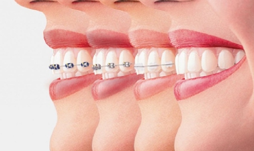Có nhiều phương pháp niềng răng phù hợp với từng tình trạng và ngân sách